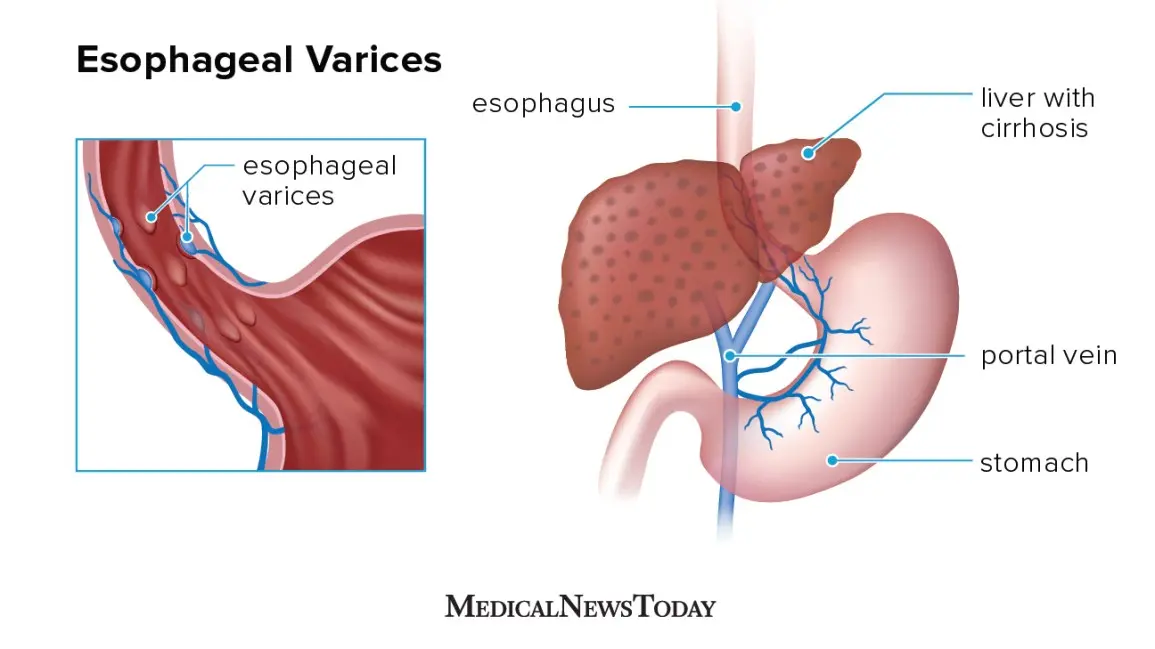 What are esophageal varices? Kamil Durczok suffered from it