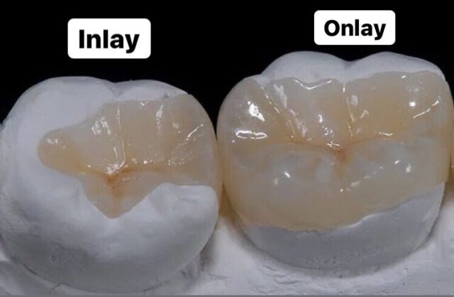 What are inlays and onlays characterized by?