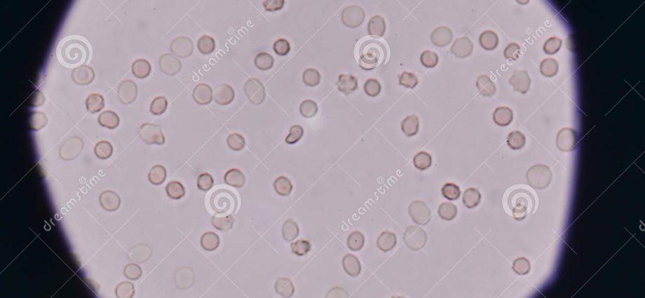 What are red blood cells fresh in the urine?