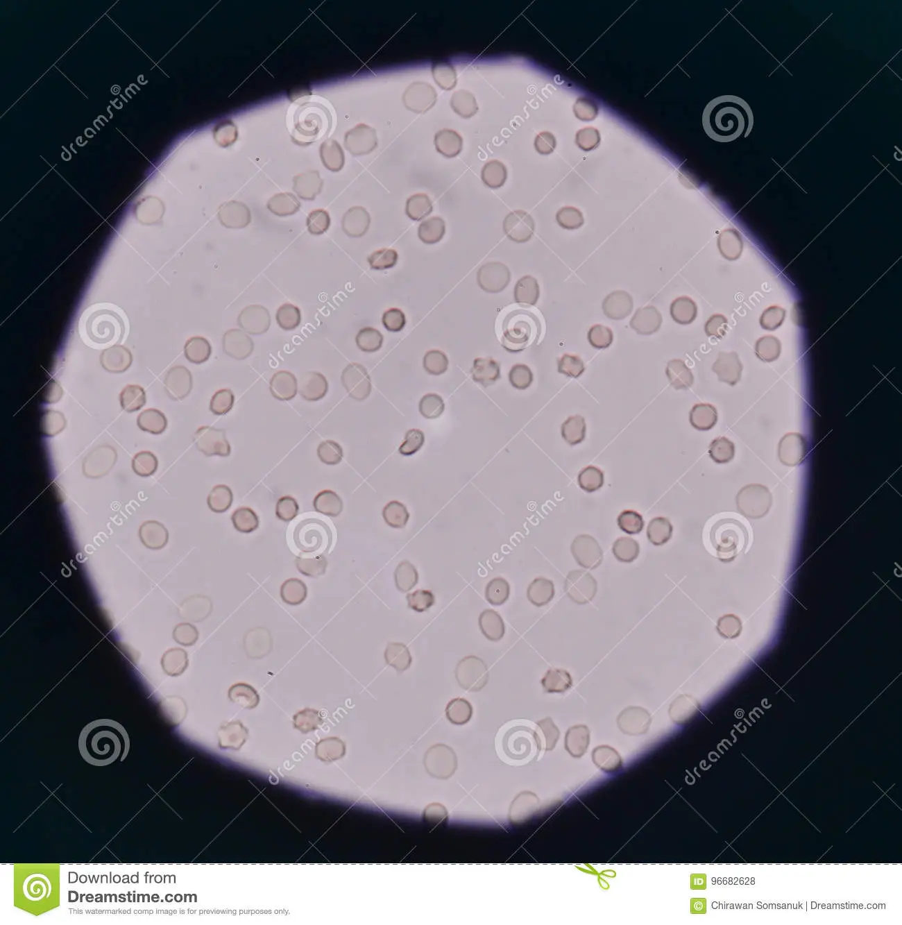 What are red blood cells fresh in the urine?