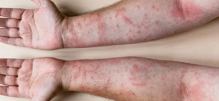 8-types-of-itchy-rash