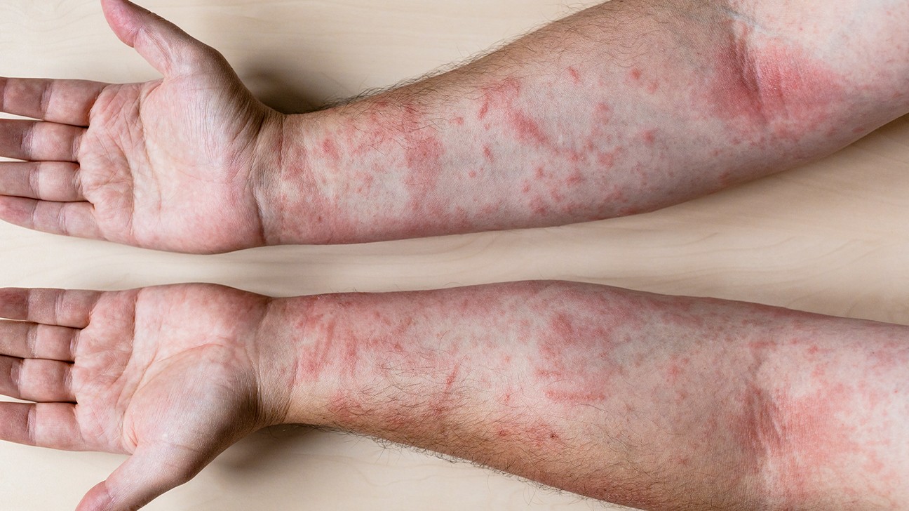 what-are-the-causes-of-an-itchy-rash-on-the-body-healthy-food-near-me