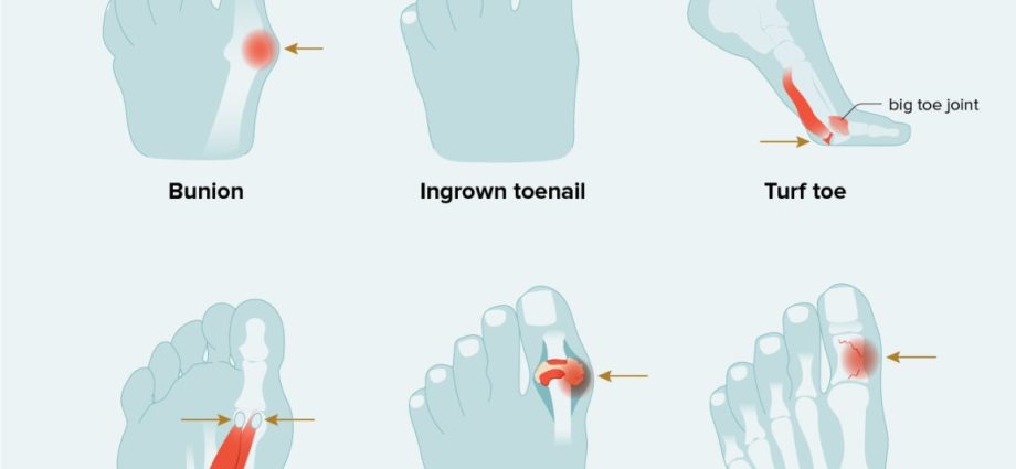 What are the causes of toe pain?