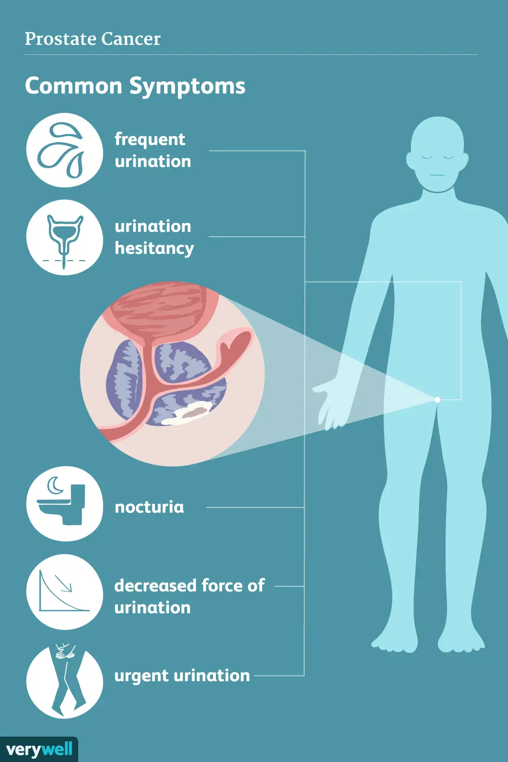 What are the first symptoms of prostate cancer?