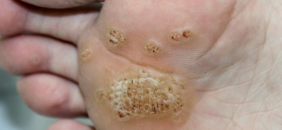 What are warts? Types and treatment of warts