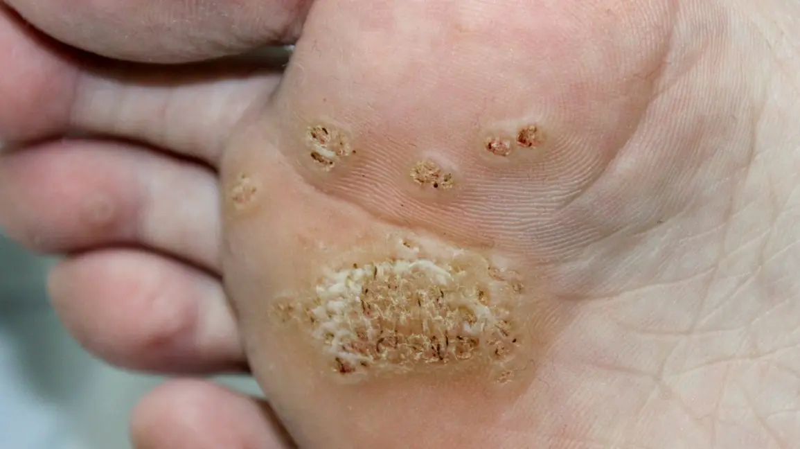 What are warts? Types and treatment of warts