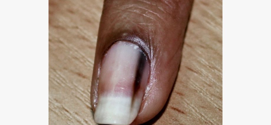 What can brown nails mean?