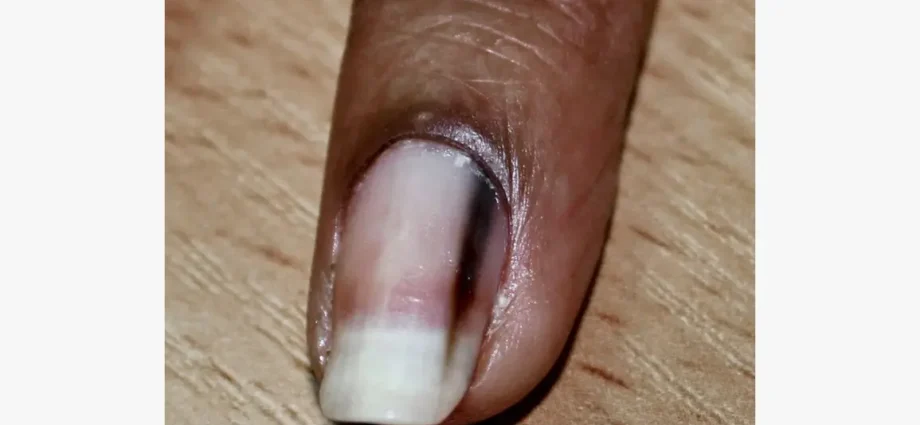 What can brown nails mean?