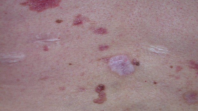 What cancer causes itchy skin? This symptom says a lot!