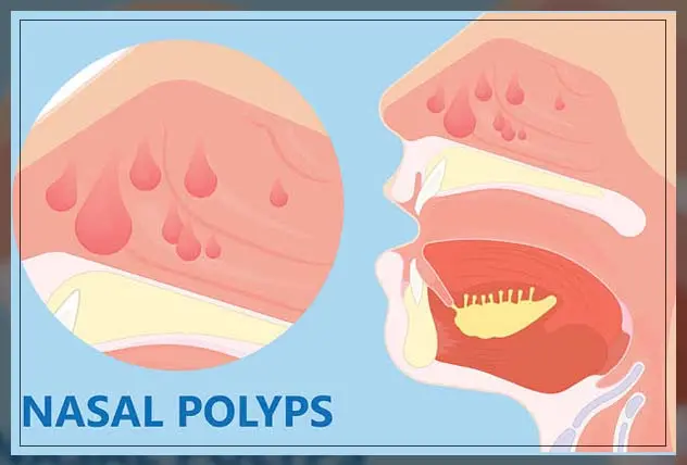 What causes a runny nose?