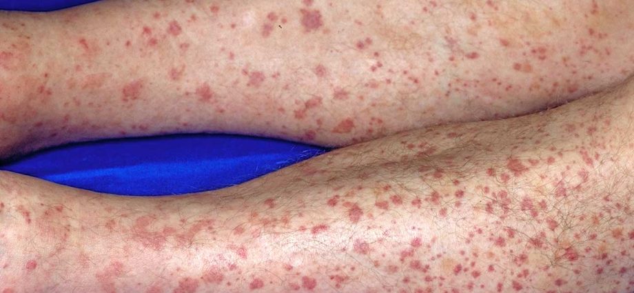 What causes red spots on the legs?