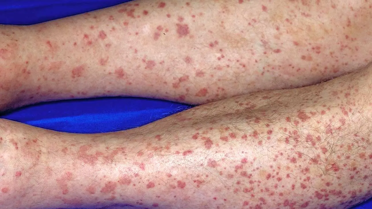 What causes red spots on the legs?