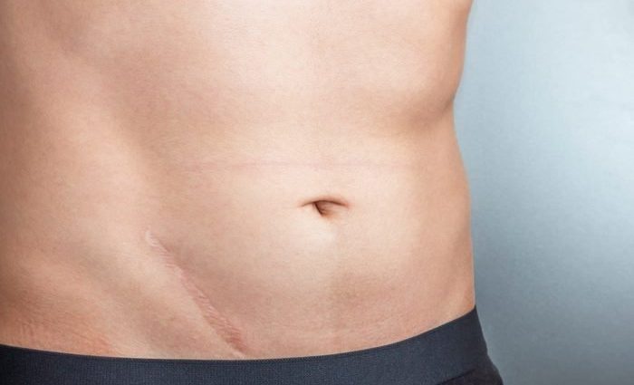 What causes stings in the lower abdomen?