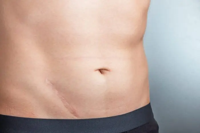 What causes stings in the lower abdomen?