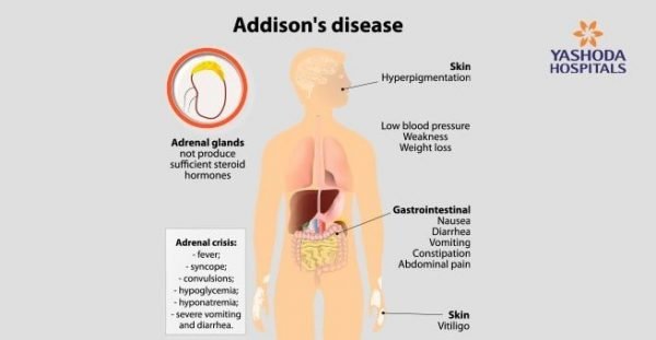 What causes the adrenal gland syndrome?