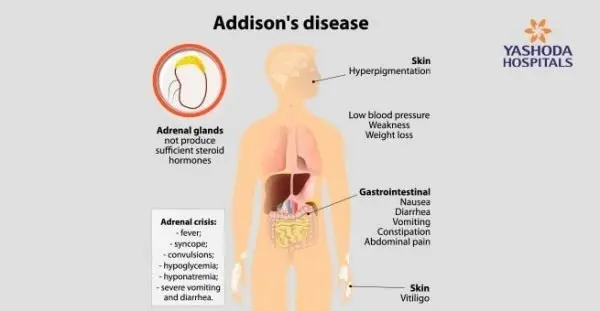 What causes the adrenal gland syndrome?