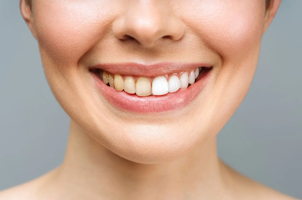 What causes tooth discoloration?