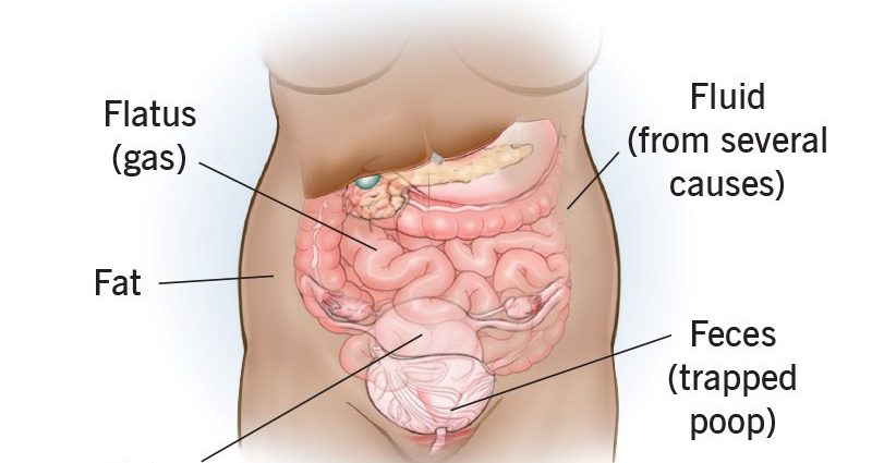 What could be the cause of a hard, bloated stomach?