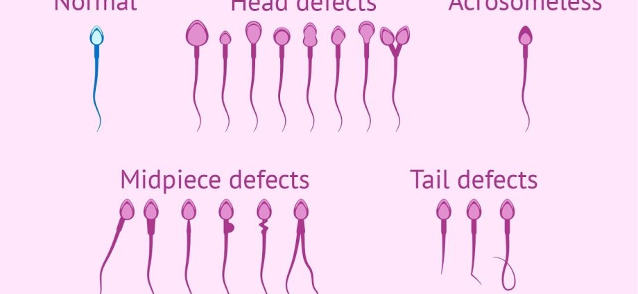 What do asthenozoospermia and teratozoospermia mean?