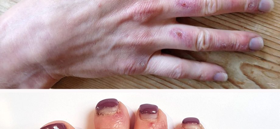 What do &#8220;covid fingers&#8221; look like? A Polish doctor published photos from the HED