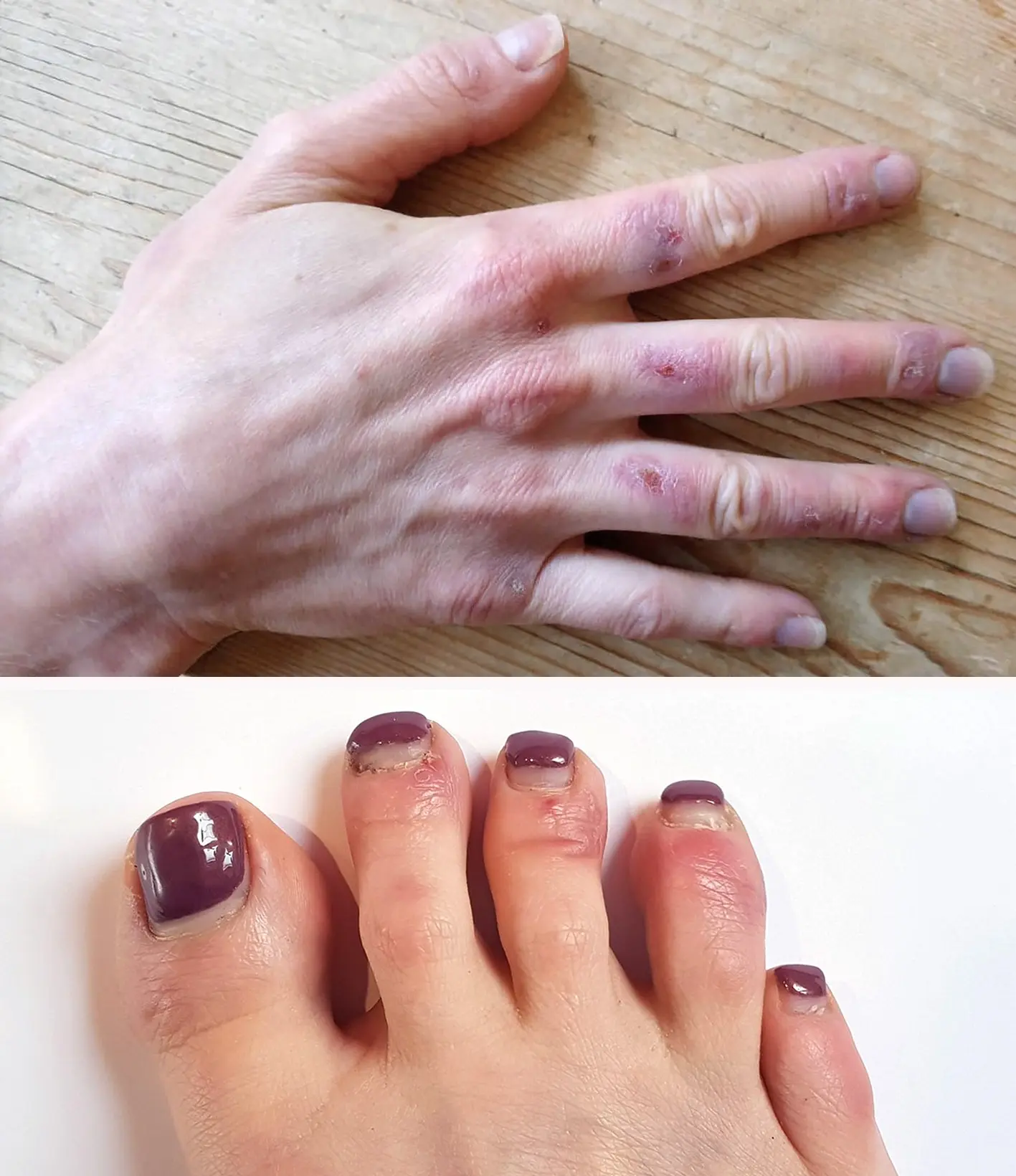 What do &#8220;covid fingers&#8221; look like? A Polish doctor published photos from the HED