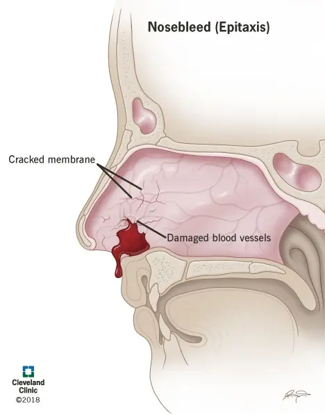 What do frequent nose bleeds show?