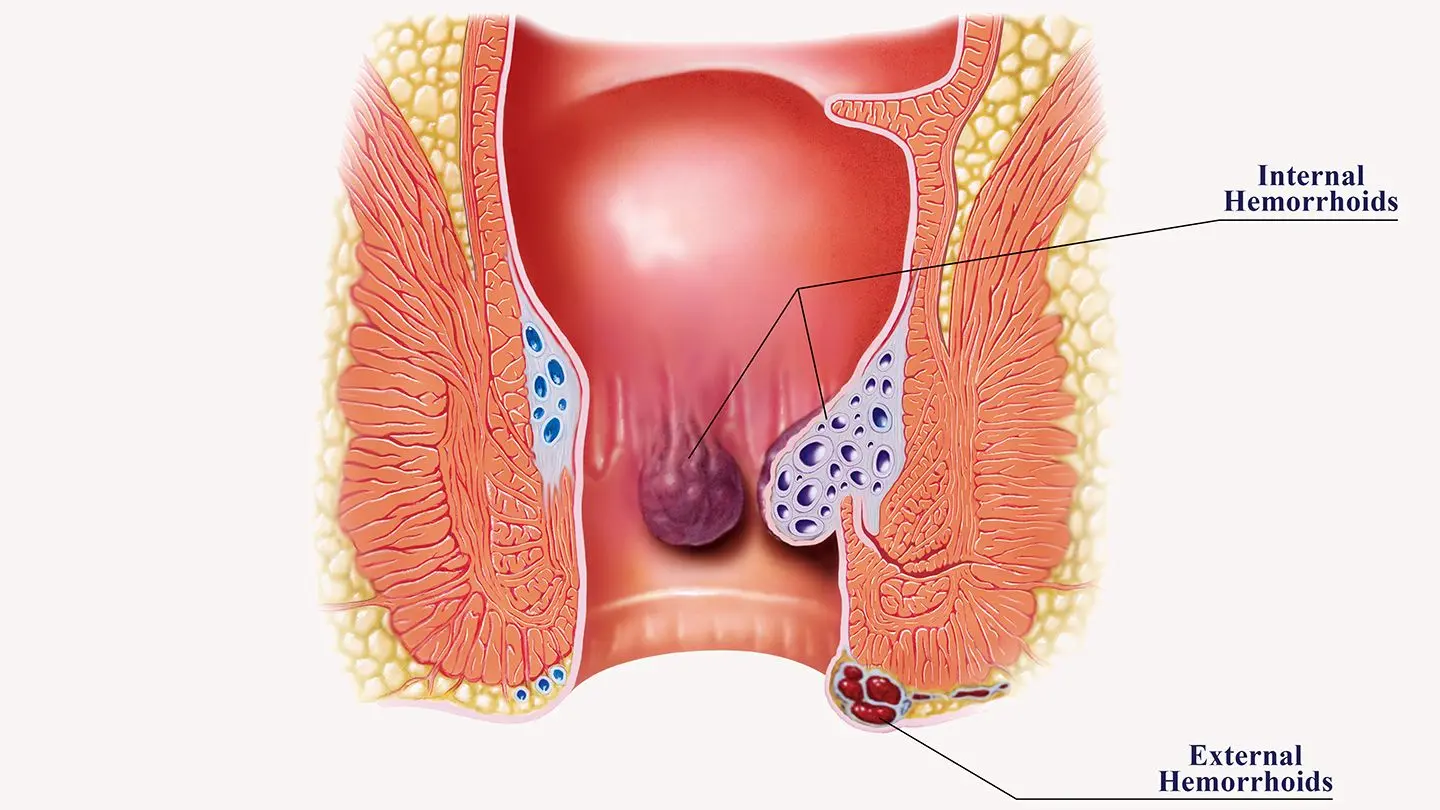 What do hemorrhoids look like and how to treat them?