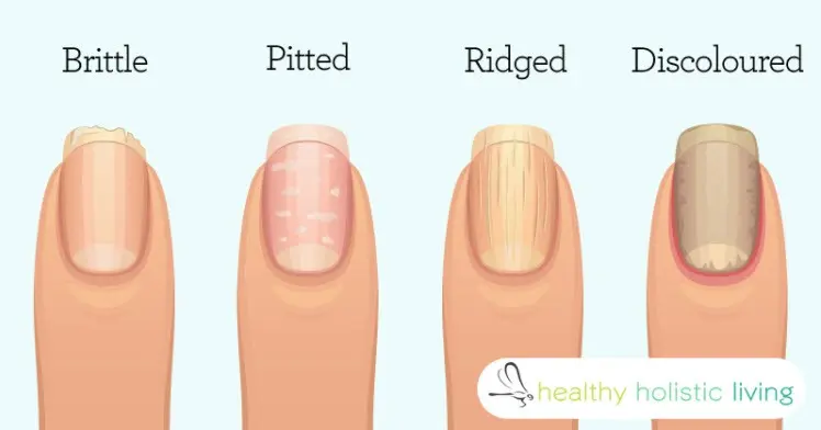 What do nails say about health? &#8220;They are like a litmus test&#8221;