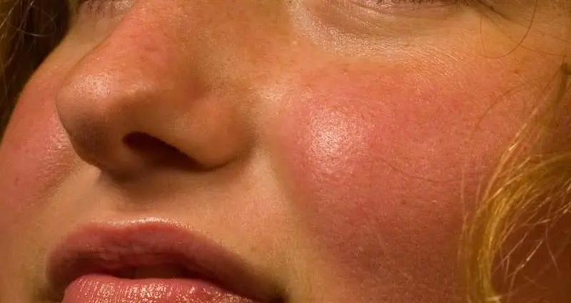 What do red cheeks mean? The doctor explains