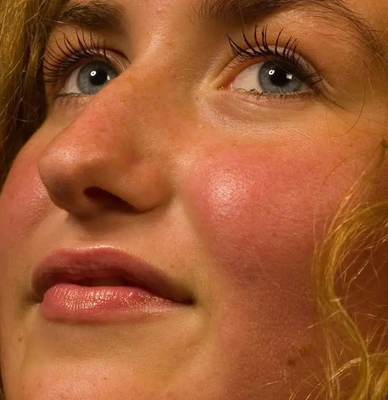 What do red cheeks mean? The doctor explains