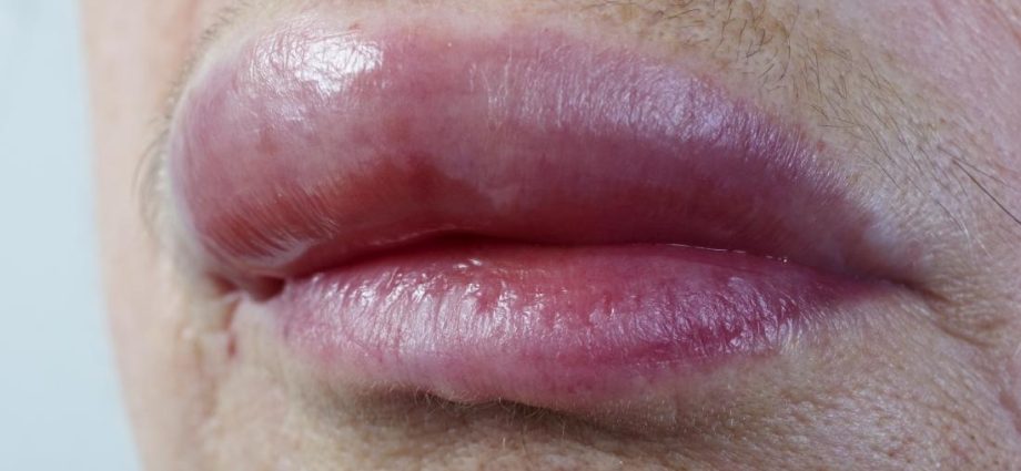 What do swollen lips say?