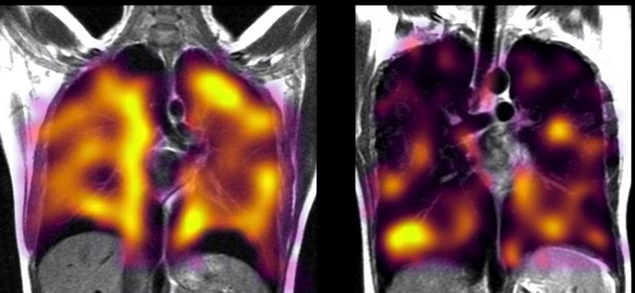 What do the lungs look like after COVID-19?