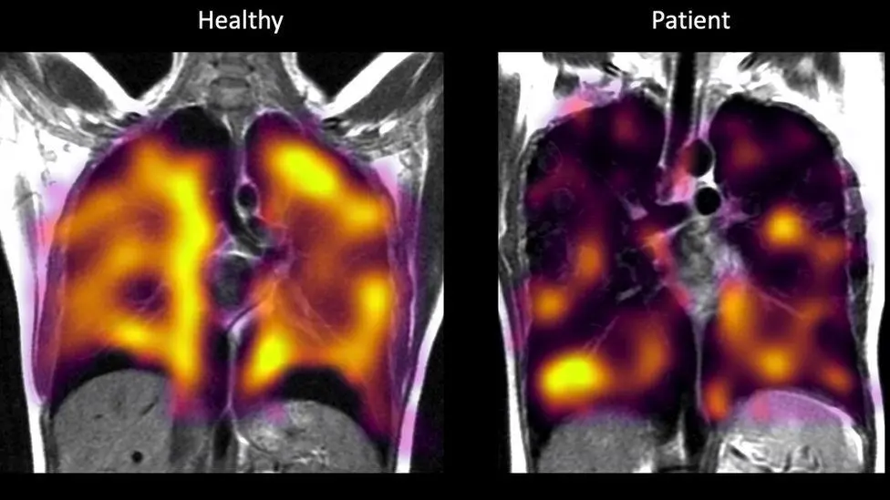 What do the lungs look like after COVID-19?