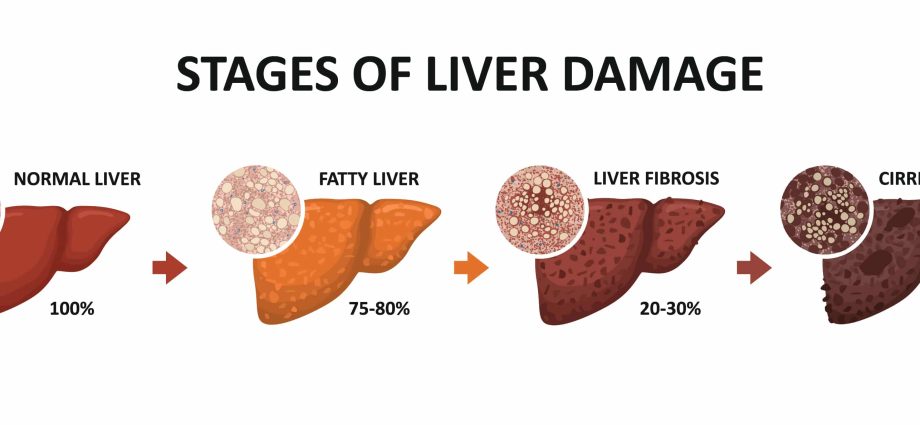 What does alcohol do to our liver? This is how the next stages of destruction look like