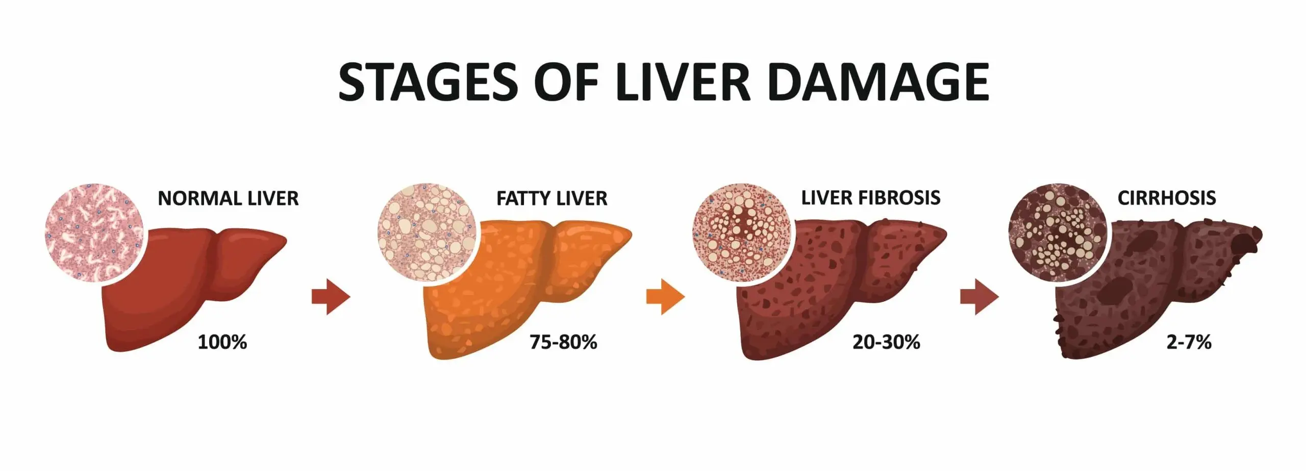 What does alcohol do to our liver? This is how the next stages of destruction look like