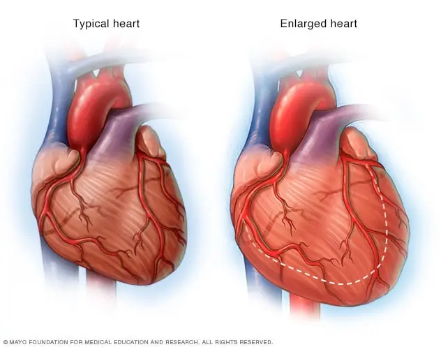 What does an enlarged heart show?