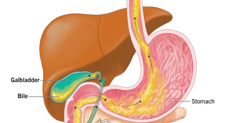 What does bile in the stomach mean?