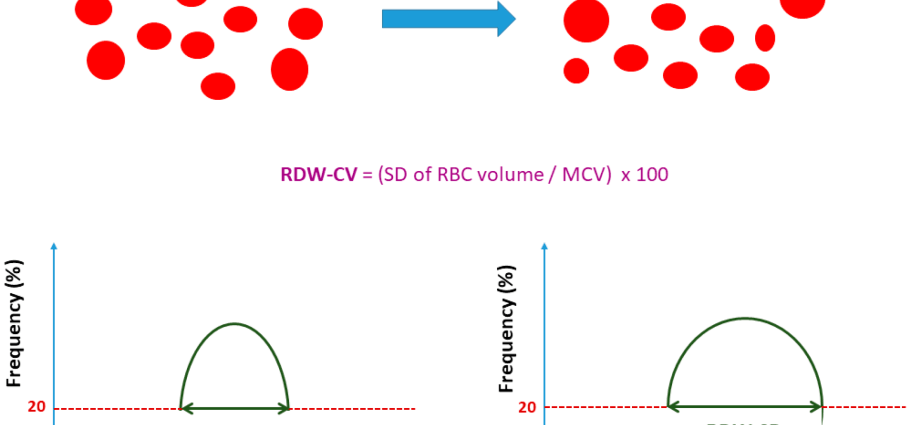 What does elevated RDW-SD mean in morphology?