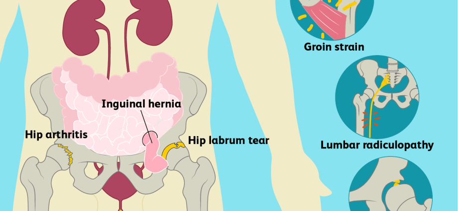 What does groin pain when walking show?