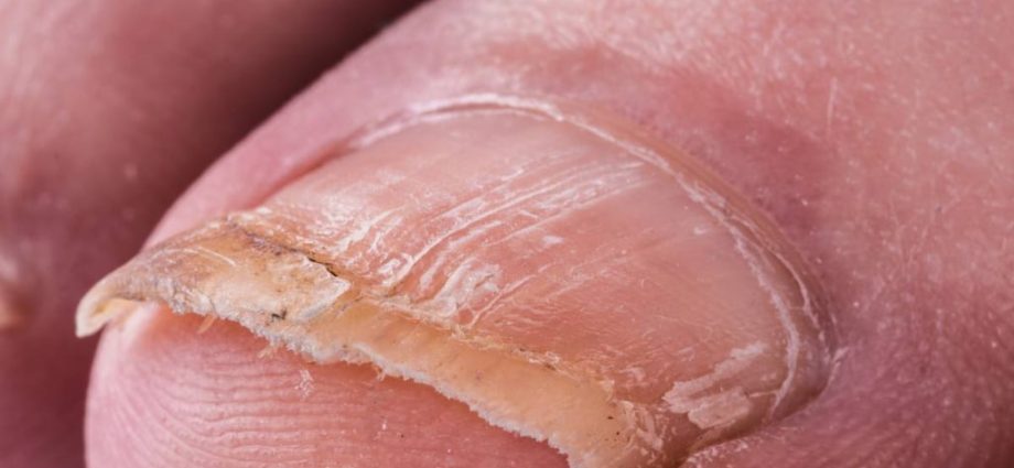 What does onychomycosis look like? Symptoms, diagnosis and treatment