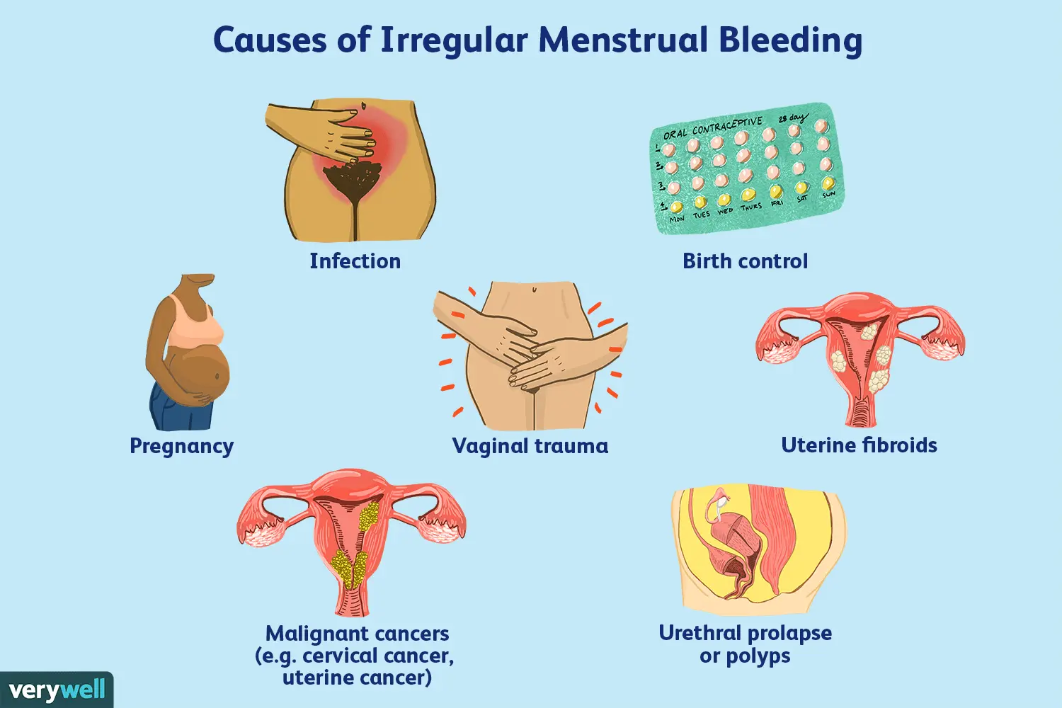 What does post-period spotting mean? Find out about the most common causes of spotting