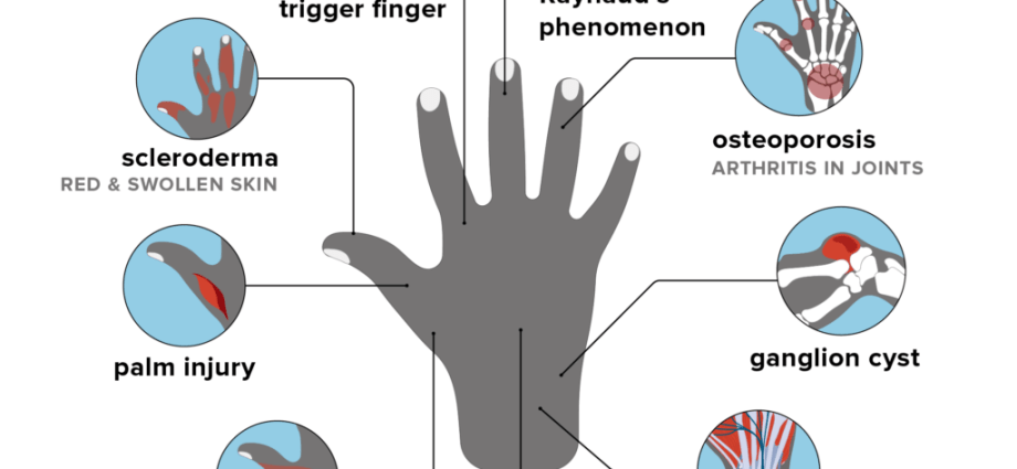 What does the pain in the left hand show?