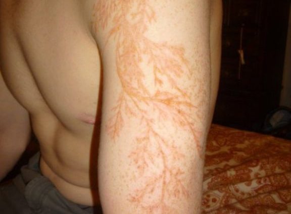 What does the skin of a person struck by lightning look like? Figures of Lichtenberg are formed on it