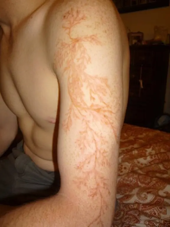 What does the skin of a person struck by lightning look like? Figures of Lichtenberg are formed on it