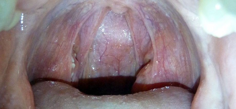 What does the white coating on the tonsils show?