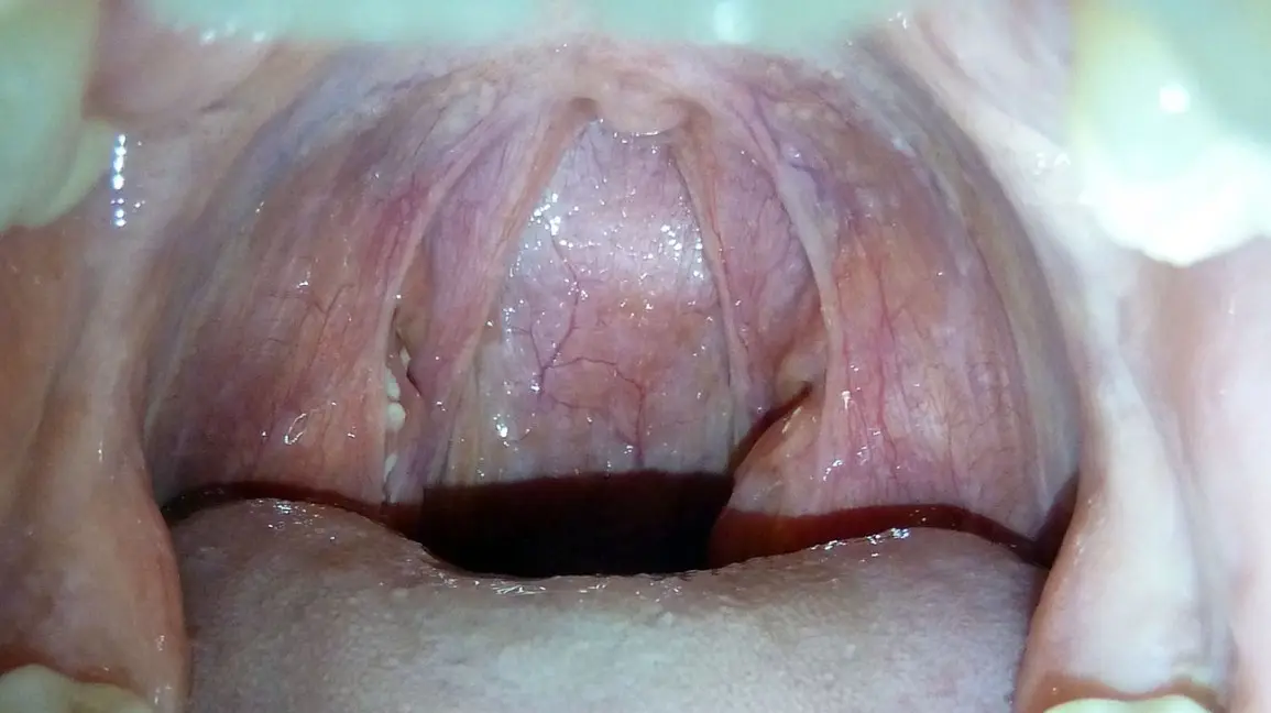 What does the white coating on the tonsils show?