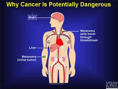 What happens in the body when a cancer grows? The doctor explains