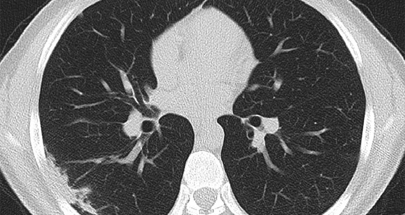 What Happens to the Lungs After COVID-19? The doctors did not encounter such complications