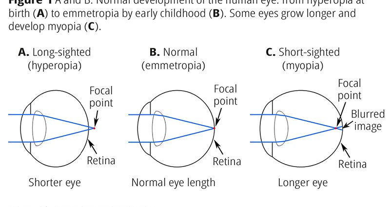 What influences the development of myopia?