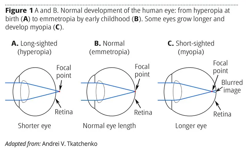 What influences the development of myopia?